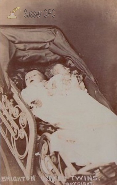 Image of Brighton - Conjoined Twins